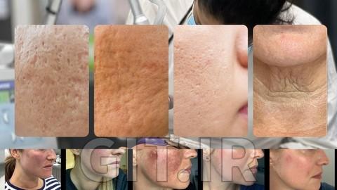 لیزر فرکشنال CO2 برای جای جوش – آموزش زیبایی
