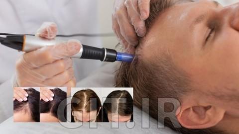 آموزش ترمیم مو: PRP + میکرونیدلینگ (Dr. Pen)