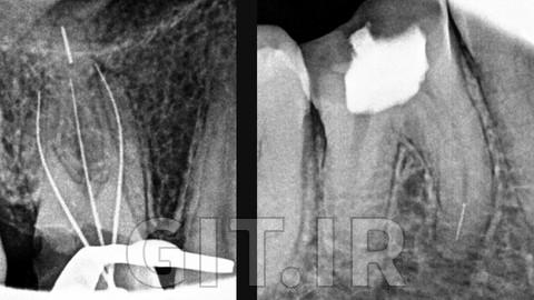 مدیریت ابزار جداشده در اندودنتیکس