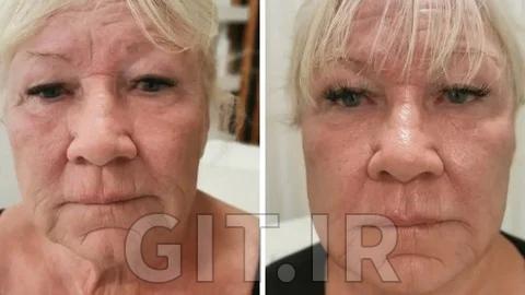مسترکلاس کامل میکرونیدلینگ ضدپیری
